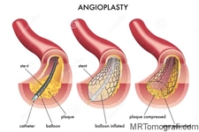 Anjiyo Sonrası Beslenme Reçetesi Anjiyo Sonrası Beslenme Reçetesi