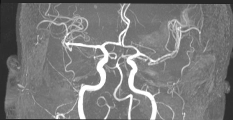 Karotis Anjiyografi (Şah Damar Tıkanıklığı)